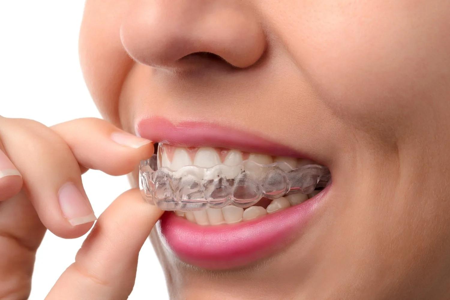 A clear aligner being fitted