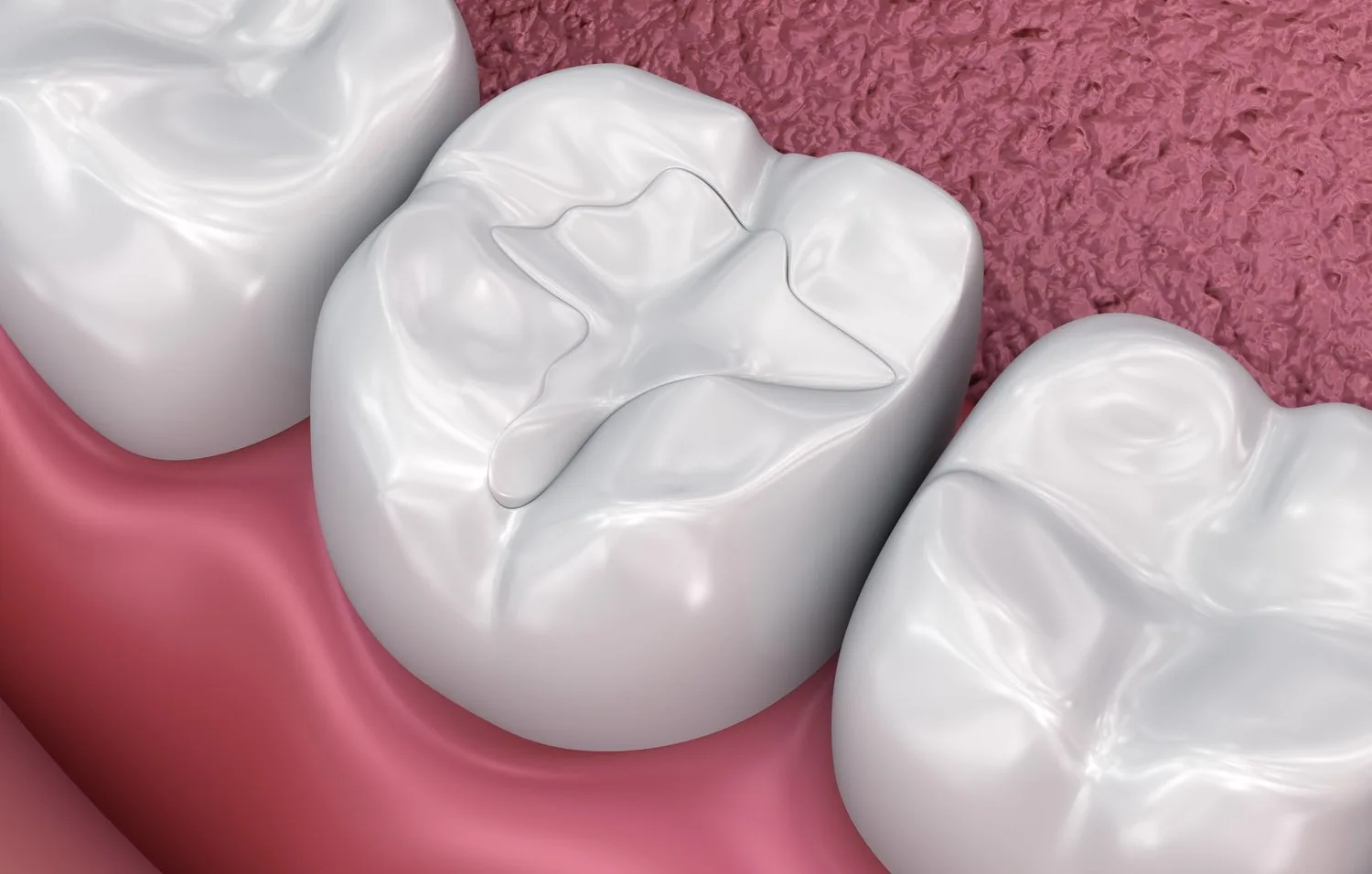 Illustration of a tooth-coloured filling in a molar