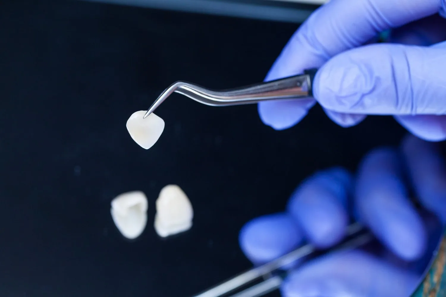 Porcelain veneers held with dental tweezers